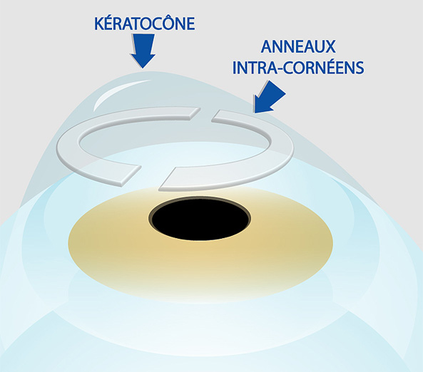 keratocone anneaux intra corneens