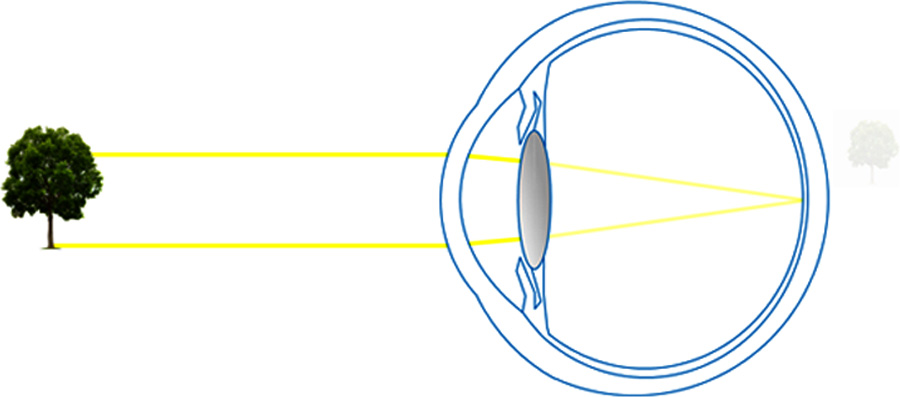 operation oeil cataracte