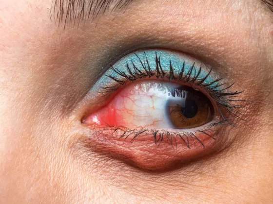 Chalazion : pourquoi le traiter avant une chirurgie réfractive ?