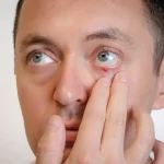 Chalazion : causes, symptômes, traitements et prévention