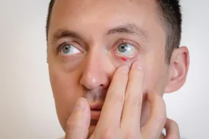Chalazion : causes, symptômes, traitements et prévention