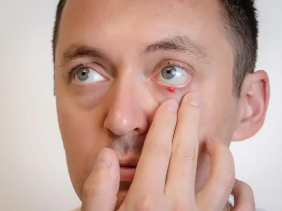 Chalazion : causes, symptômes, traitements et prévention