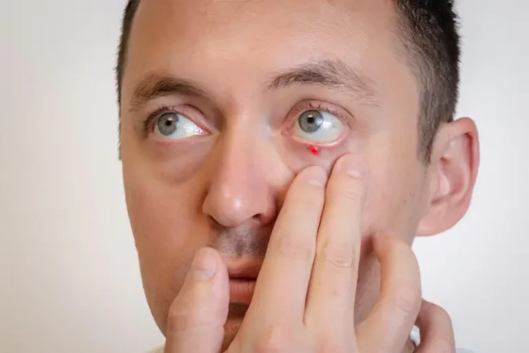 Chalazion : causes, symptômes, traitements et prévention