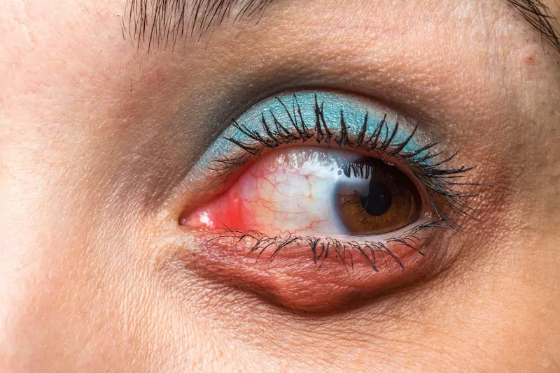 Chalazion : causes, symptômes, traitements et prévention