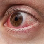 Peut-on faire une chirurgie réfractive quand on a un glaucome ?
