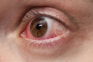 Peut-on faire une chirurgie réfractive quand on a un glaucome ?