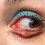 Chalazion : prévention et traitements modernes en 2025