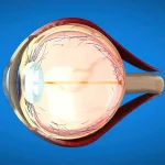 Cataracte 2025 : diagnostic précoce et signes d’alerte