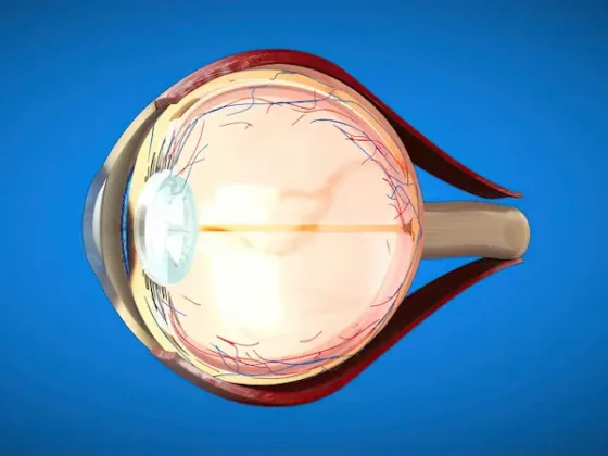 Cataracte 2025 : diagnostic précoce et signes d’alerte